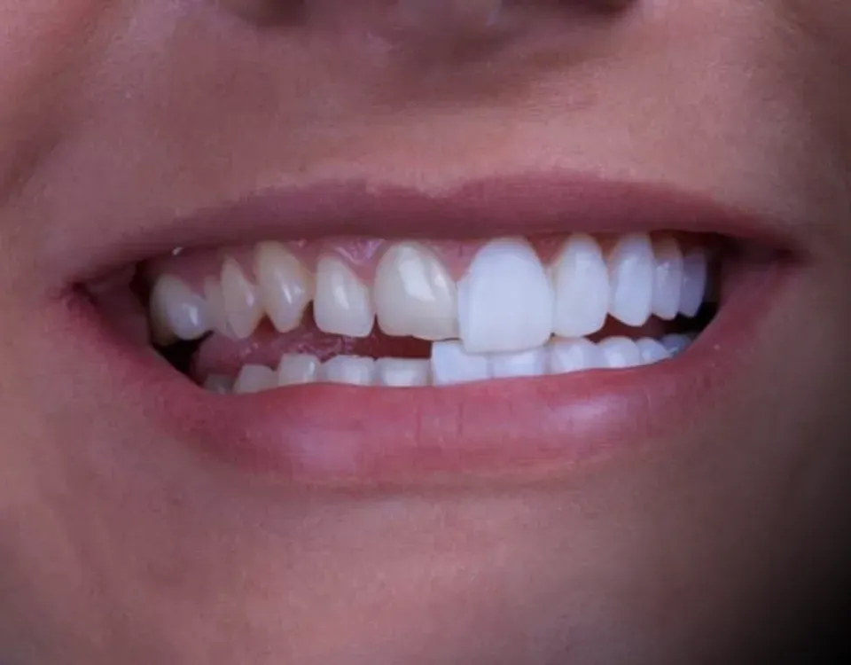 Cosmetics & Veneers