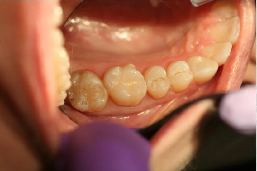Tooth-colored fillings, molar decay, after