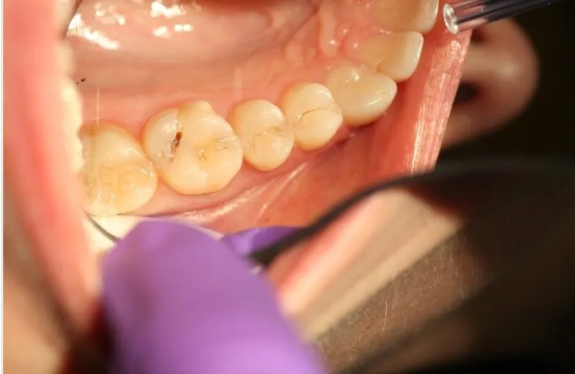 Tooth-colored fillings, molar decay, before