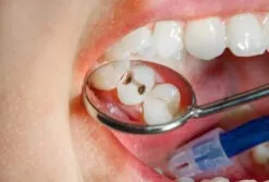 Small cavity repair, before