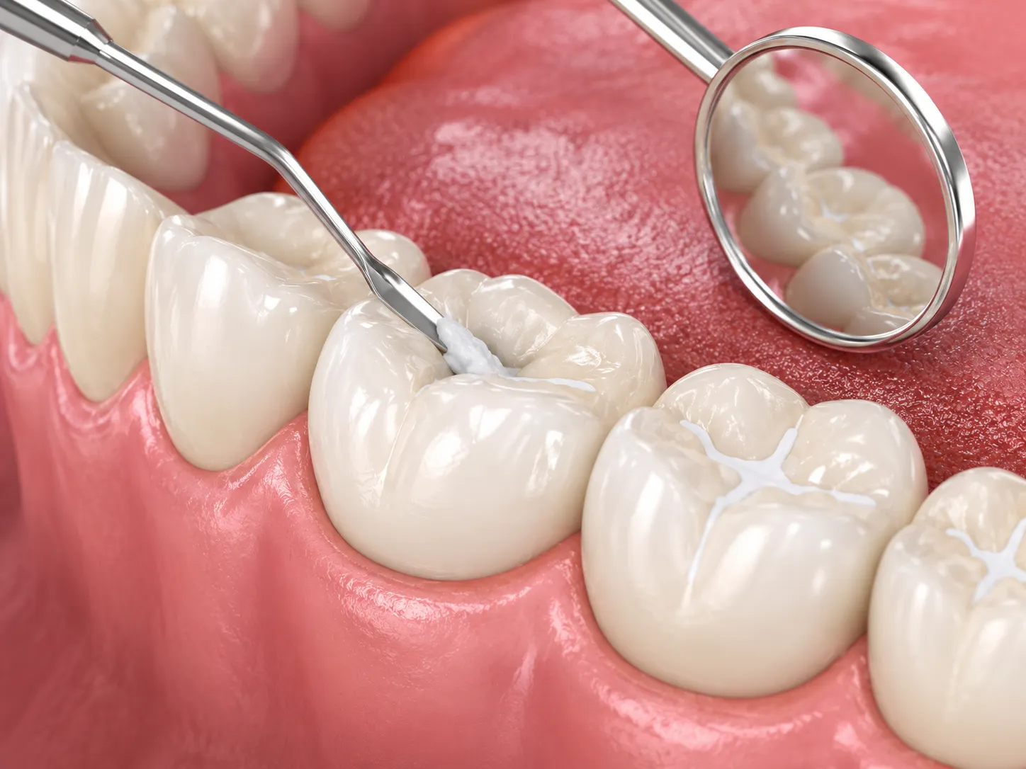 Fillings & Sealants
