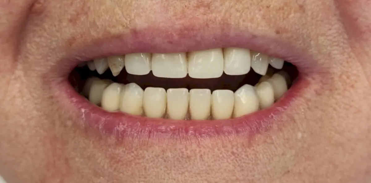 Full mouth rehabilitation, after