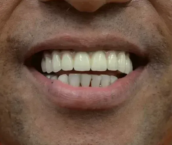 Implant-supported reconstruction, after