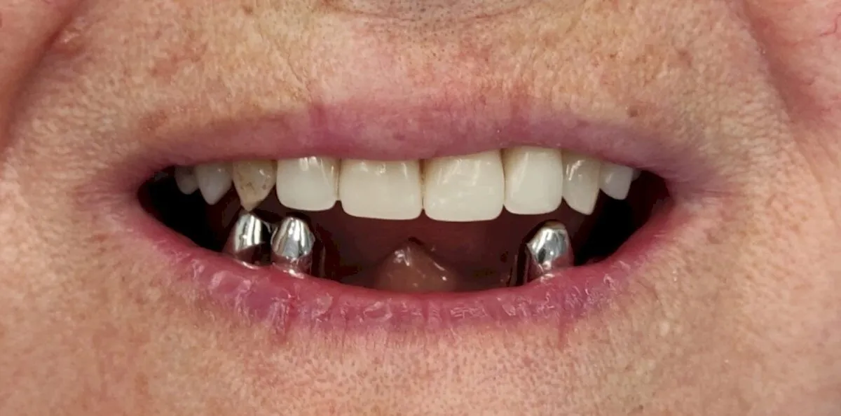 Full mouth rehabilitation, before