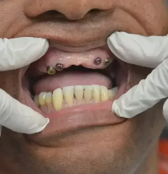 Implant-supported reconstruction, before