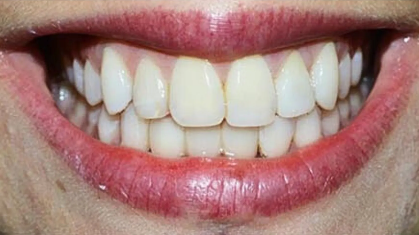 Dental implants, after