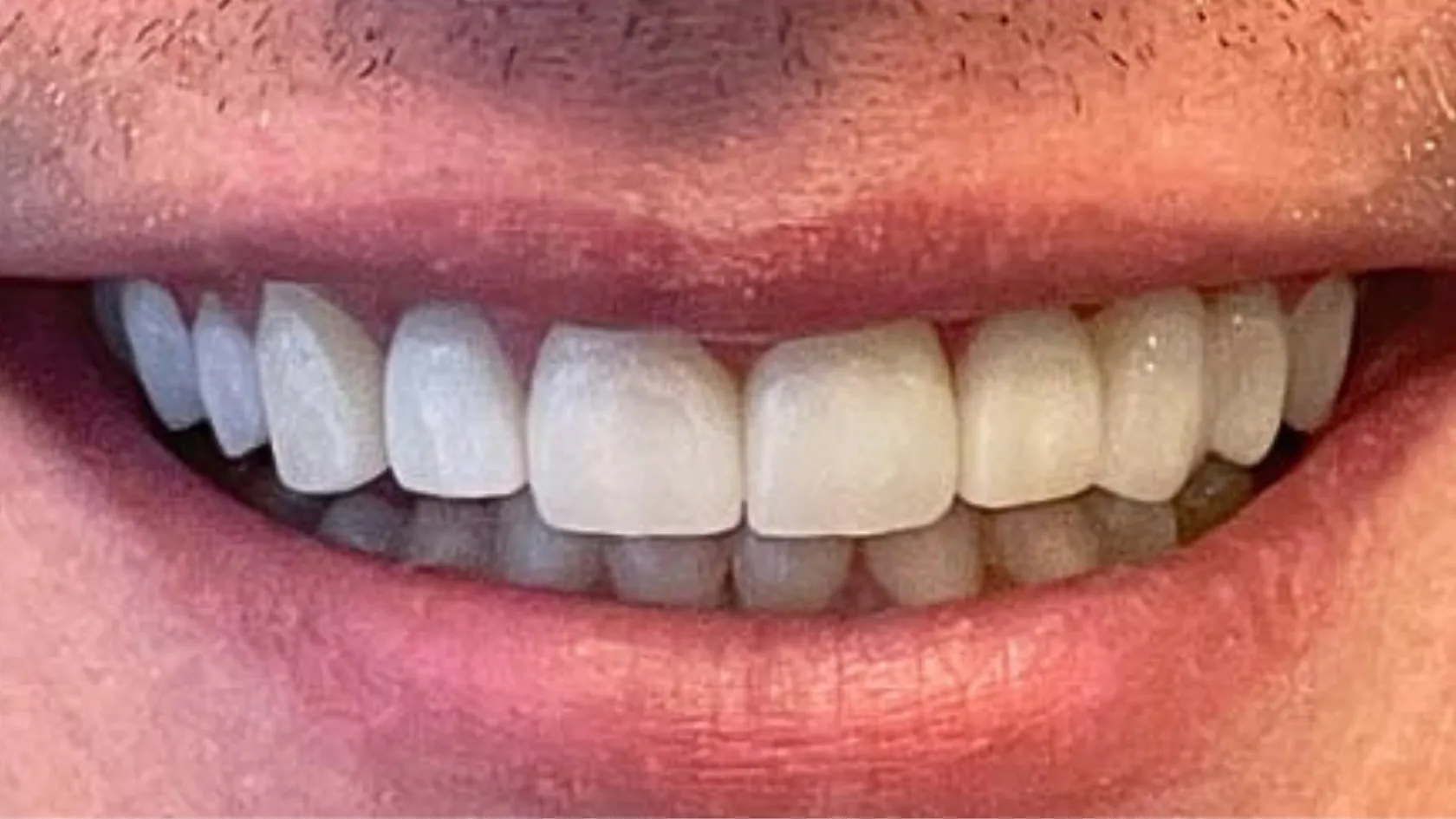 Dental implants, after