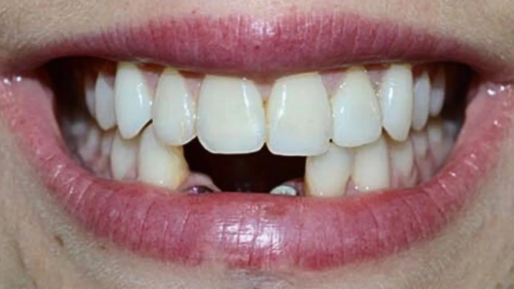 Dental implants, before