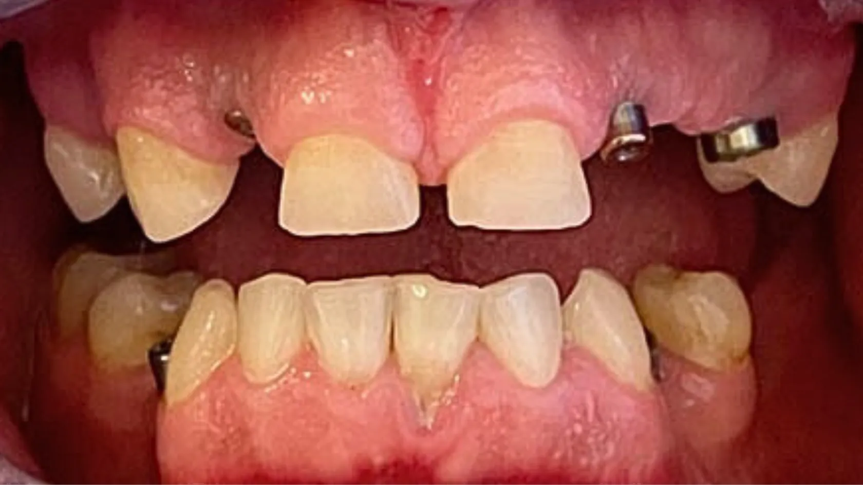 Dental implants, before