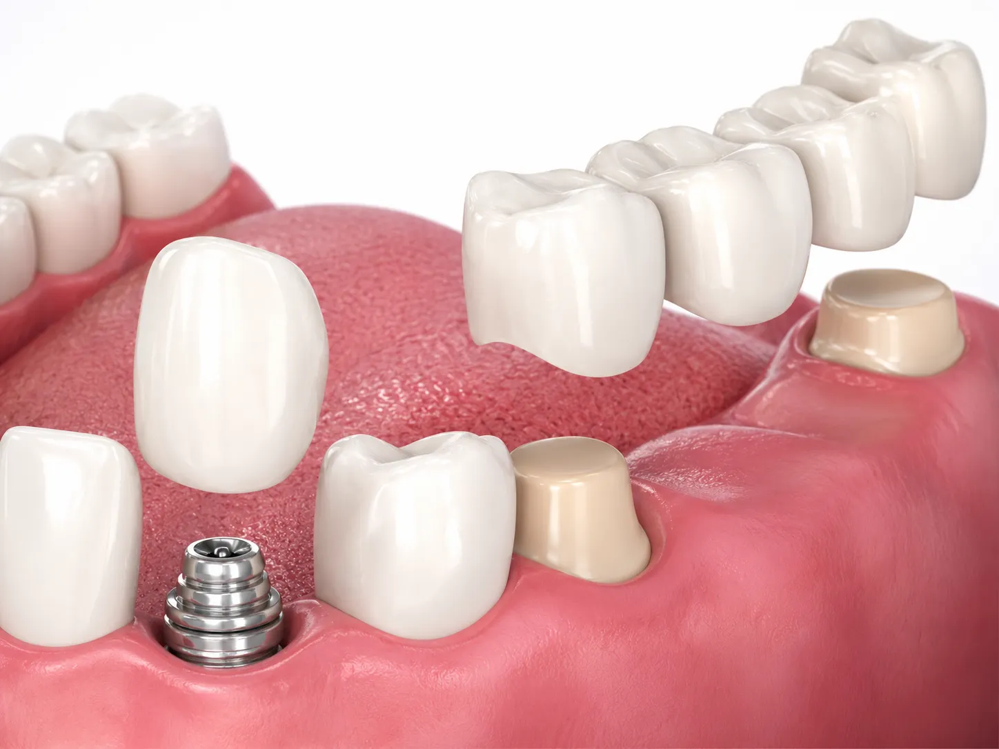 Implants & Bridges