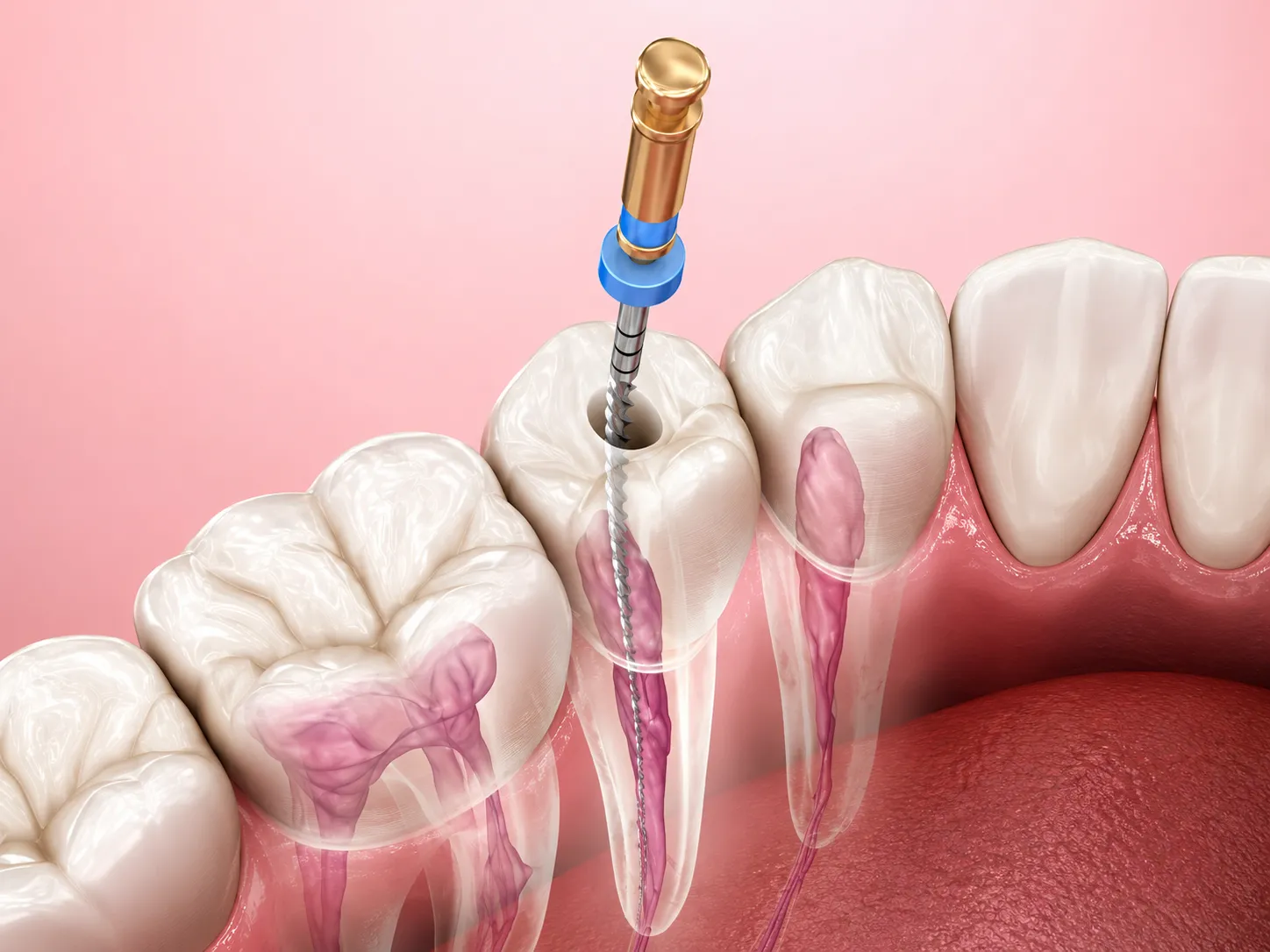 Tooth Extraction dental treatment in Mount Prospect, IL