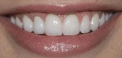In-office Zoom whitening, single visit, after