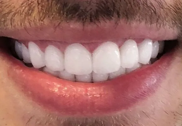 Full upper veneer makeover, after