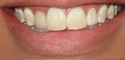 In-office Zoom whitening, single visit, before