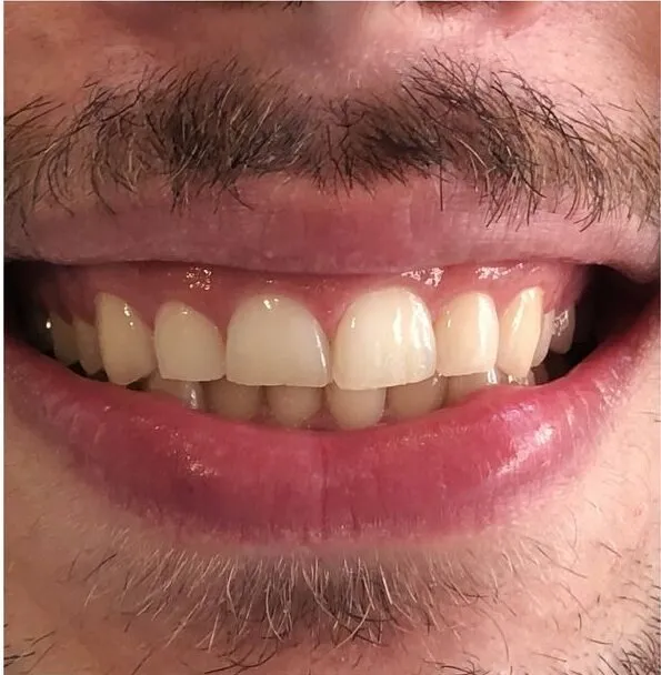 Full upper veneer makeover, before