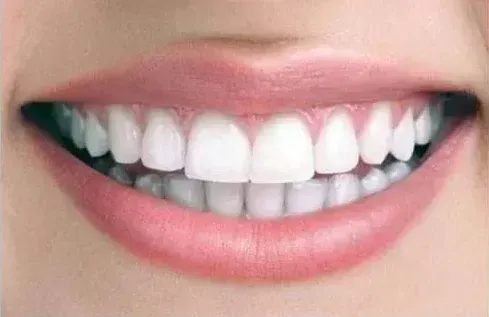 Professional whitening, coffee & wine stains, after