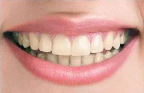 Professional whitening, coffee & wine stains, before